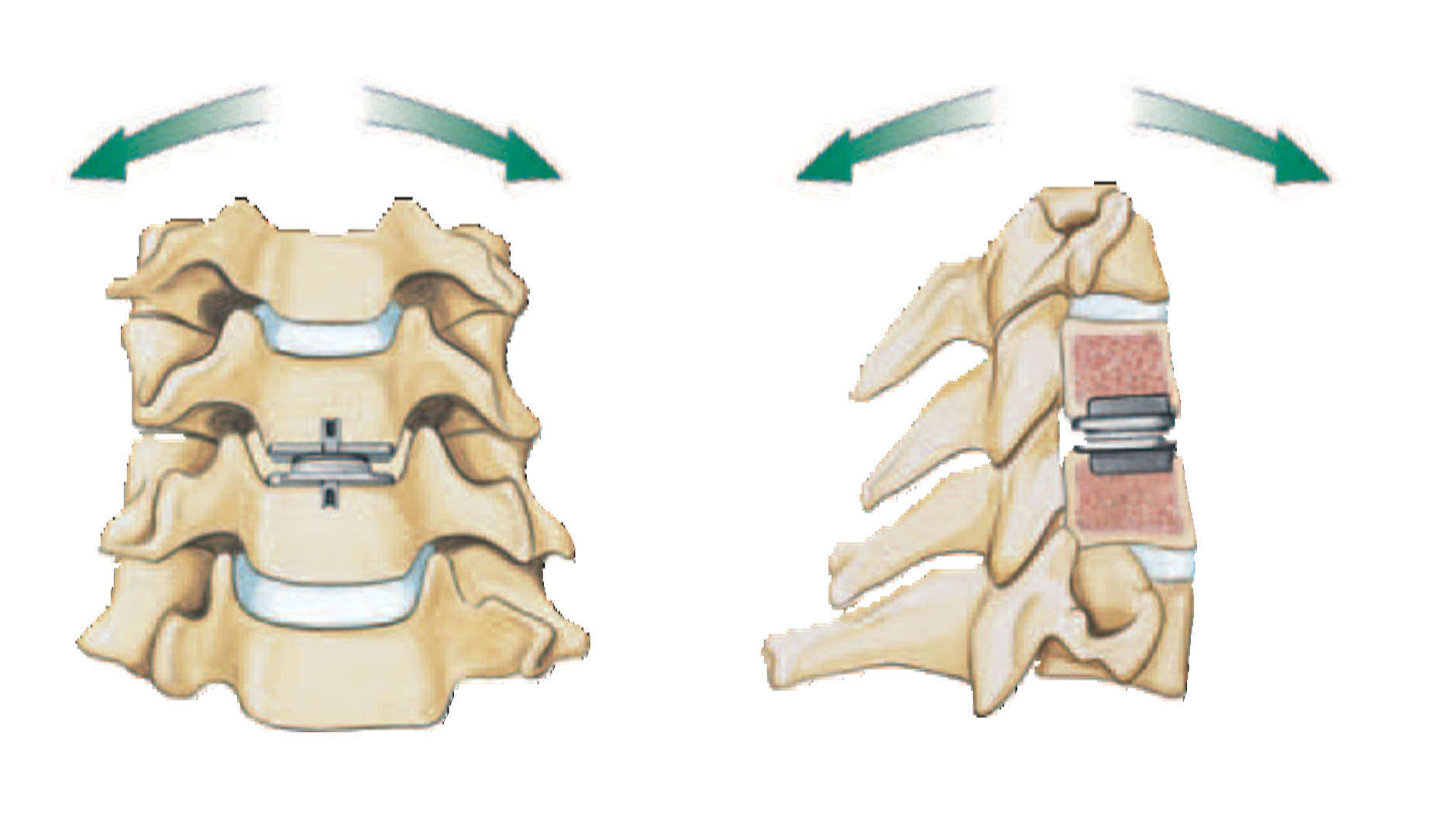 San Antonio prodisc C Total Disc Replacement TX Spine Doctor